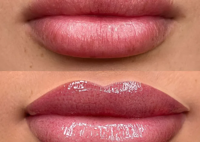 Cold Sores After Lip Blush? Explained